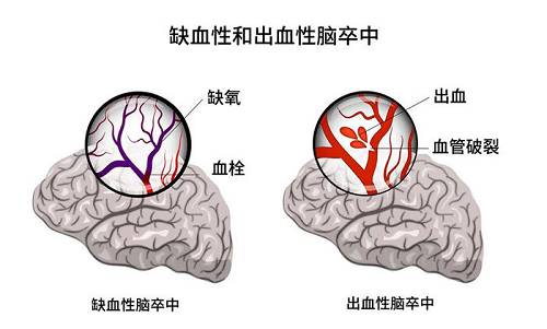 脑梗引起视力模糊竟是“烟雾病”惹的祸(图6)